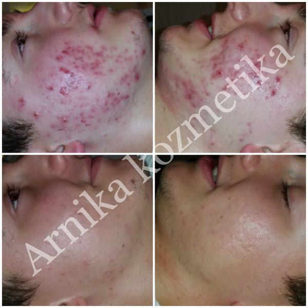 Čišćenje lica - akni i mitesera - Arnika kozmetika