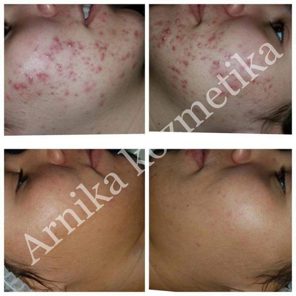 Čišćenje lica - akni i mitesera - Arnika kozmetika