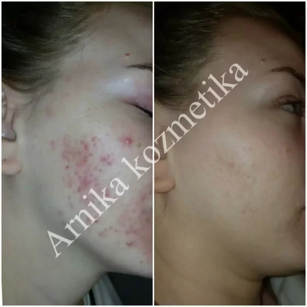 Liječenje akni i mitesera na licu - slika prije i poslije - Arnika kozmetika
